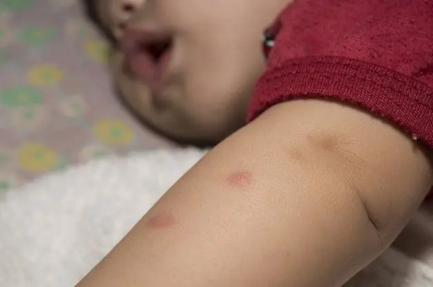 "IMSS Guerrero Enfatiza Prevención del Dengue". Los síntomas en adultos se identifican como dolor de cabeza, dolor articular, malestar general y decaimiento